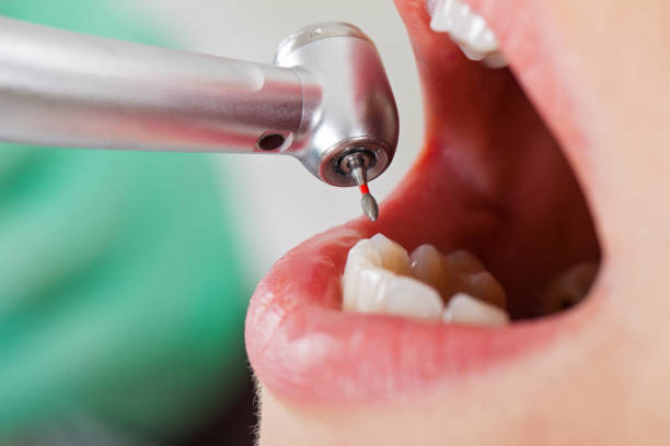 Best Emergency Dental Care for Broken or Chipped Teeth in Port Hadlock Irondale, WA
